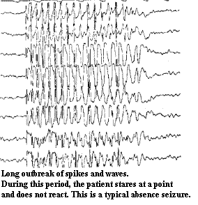 Long outbrake of spikes and waves.